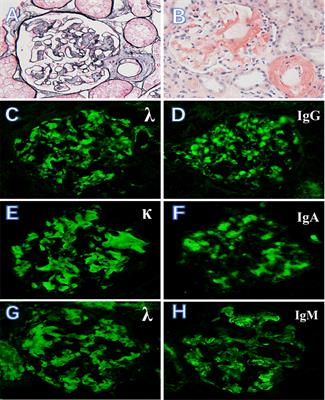 Clinical characteristics and prognostic value of renal immune complex deposition in patients with light chain amyloidosis